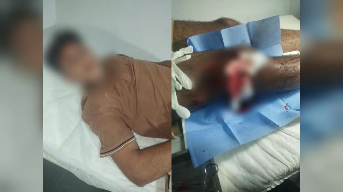 Ferimento na perna de vítima atingida por disparo, durante atendimento.